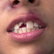 oral injuries