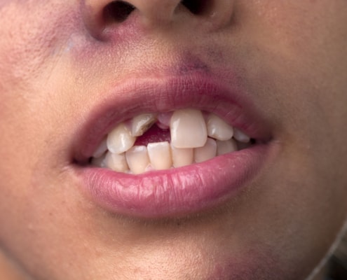 oral injuries