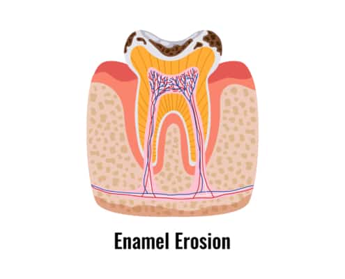 enamel erosion